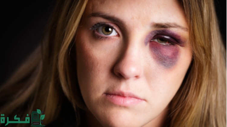 طريقة ازالة آثار كدمات قديمة
