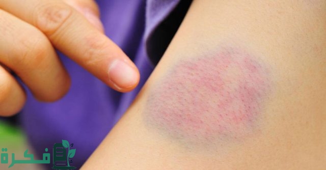 طريقة ازالة آثار كدمات قديمة