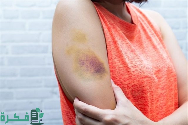 طريقة ازالة آثار كدمات قديمة