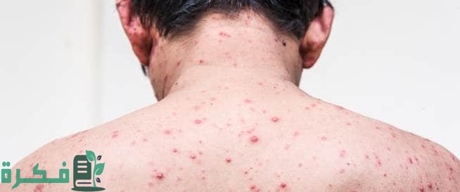 طريقة العناية بمنطقة الظهر المصابة بحب الشباب