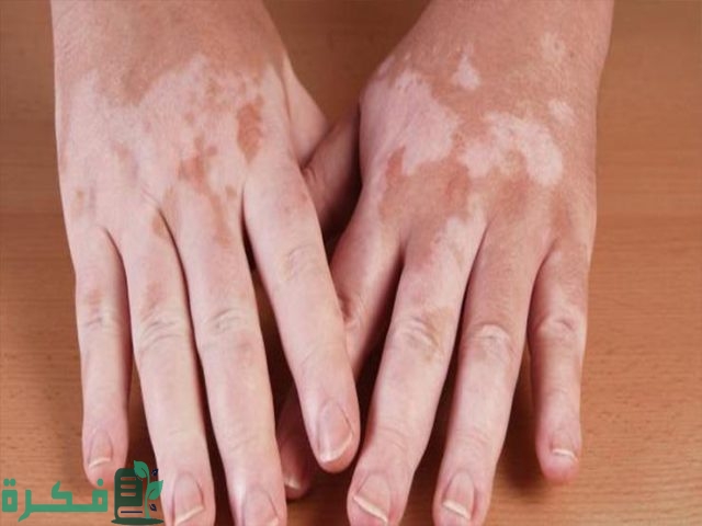 طريقة علاج البهاق بالكبريت