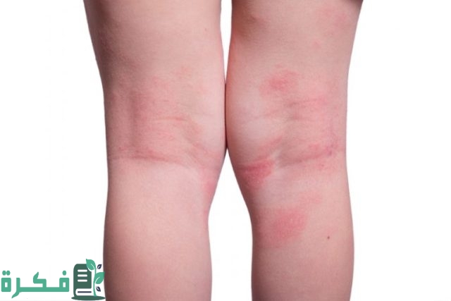 علاج التسلخات بين الفخدين في المنزل