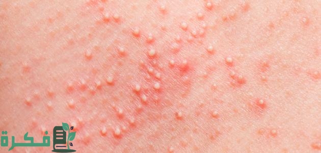 علاج التسلخات بين الفخدين في المنزل