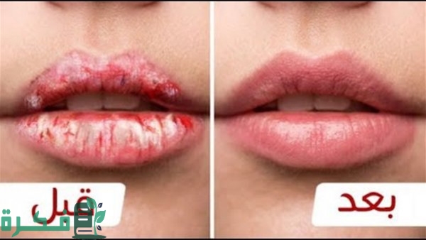 أفضل كريم لعلاج تشقق الشفاه