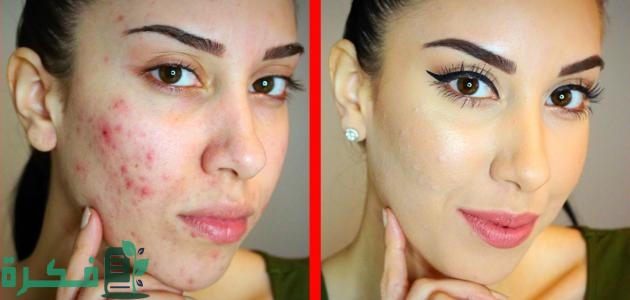 مدة اختفاء آثار حب الشباب