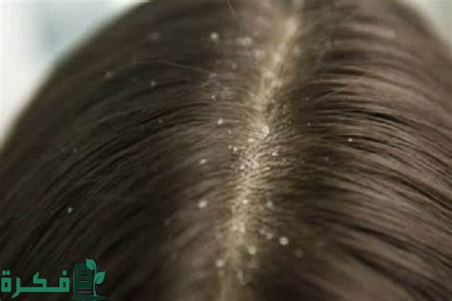 هل يفقس بيض القمل خارج الشعر؟