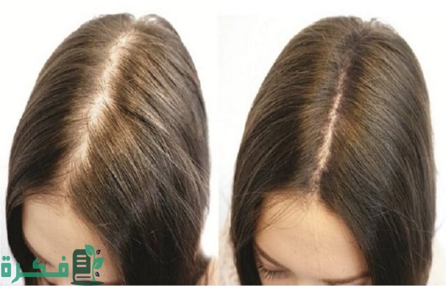 جهاز انبات الشعر بالليزر