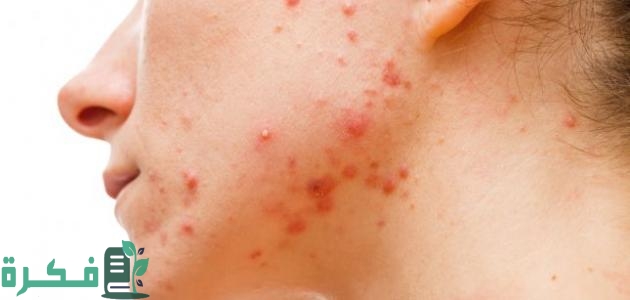 ظهور حبوب في الجسم أثناء الحمل وجنس الجنين