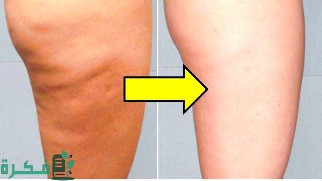 وصفات لإزالة السيلوليت من الأرداف