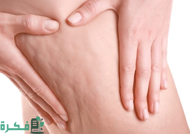 وصفات لإزالة السيلوليت من الأرداف