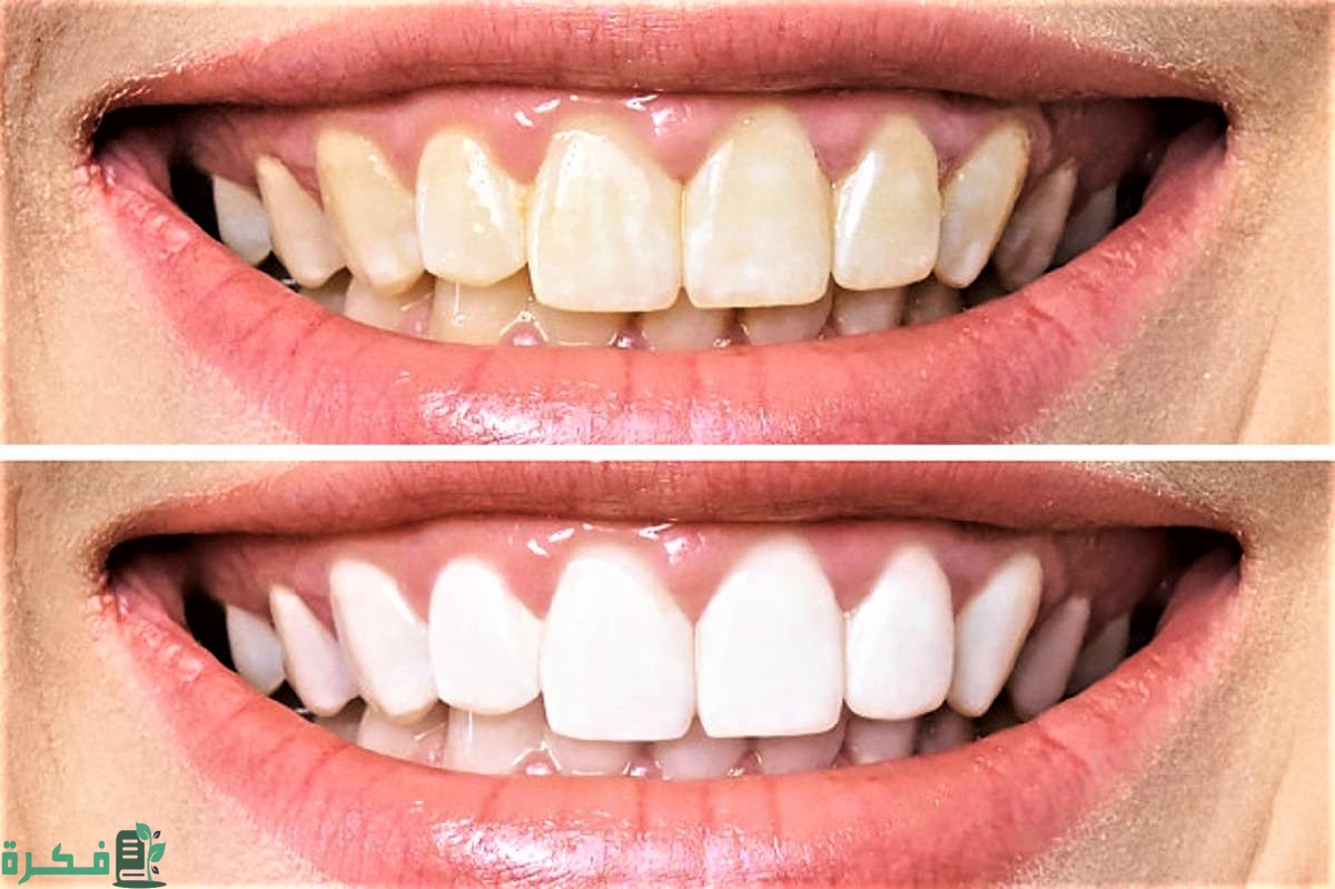وصفة سحرية بسيطة لتبييض الأسنان كالثلج في يوم واحد