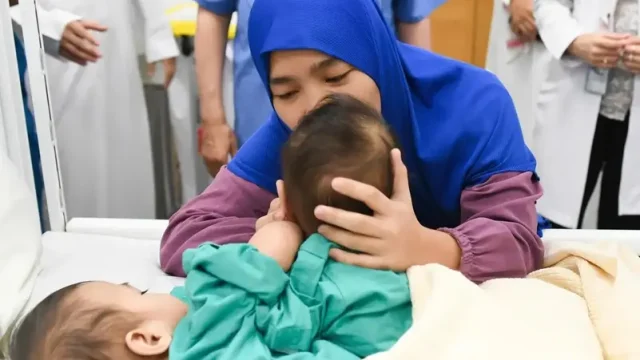 نجاح فصل التوأم السيامي الفلبيني "أكيزا وعائشة"