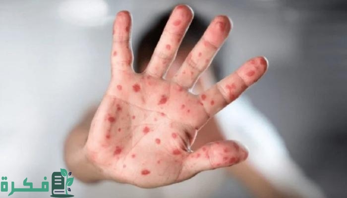 “وقاية” تصدر بيان هام بشأن فيروس جدري القرود النمط الأول Mpox بالمملكة وعالميًا