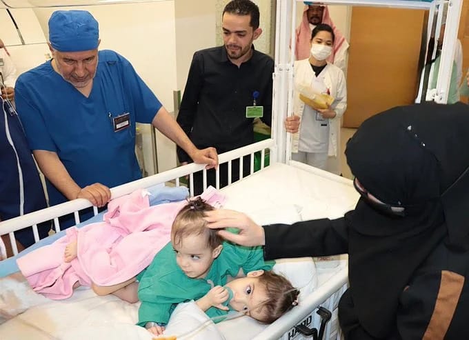 بدء عملية فصل التوأم السيامي السوري "سيلين وإيلين" في مستشفى عبد الله التخصصي تستغرق 9 ساعات